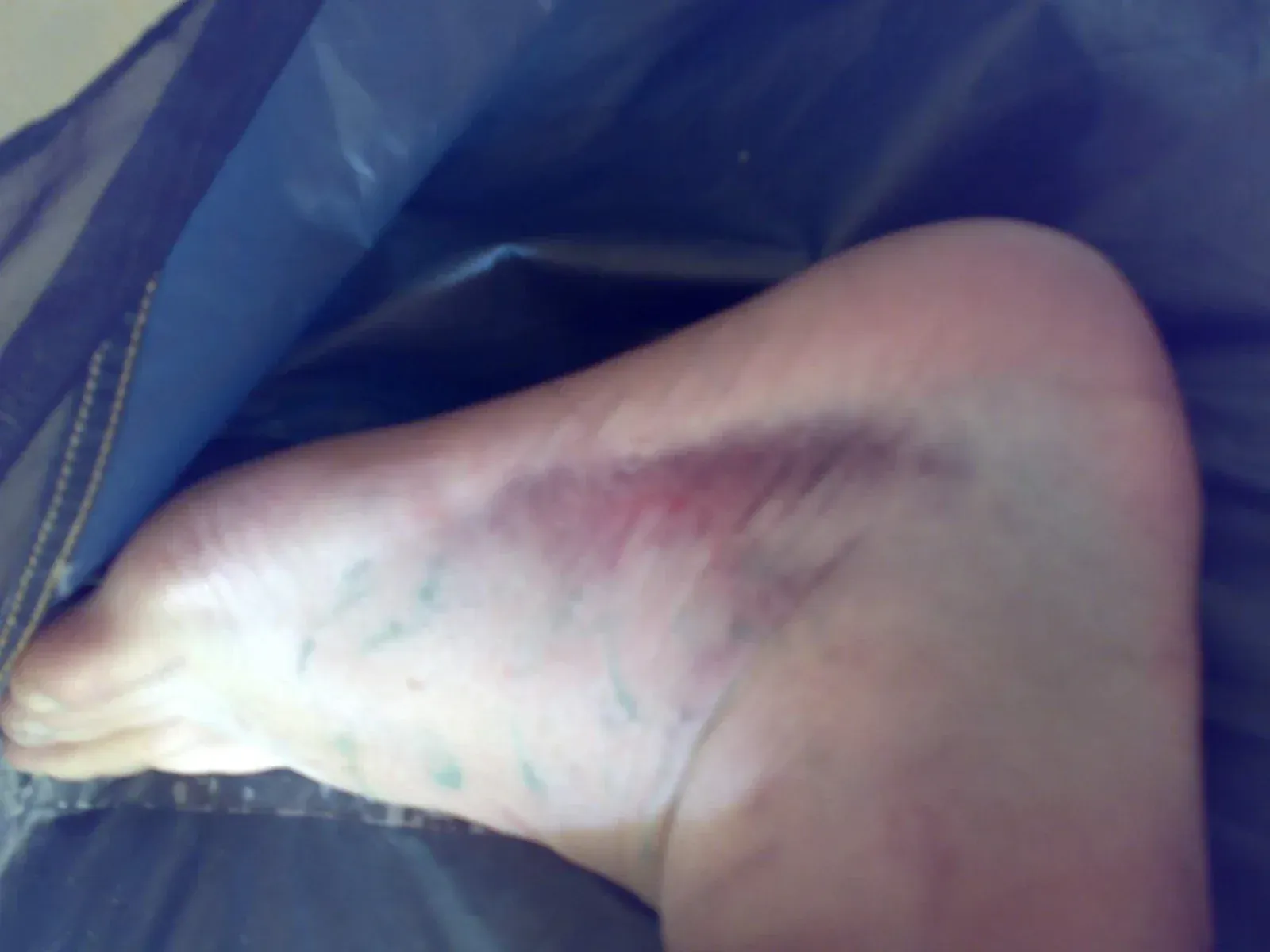 Close-up of badly swollen sprained ankle, black and blue bruising across the instep